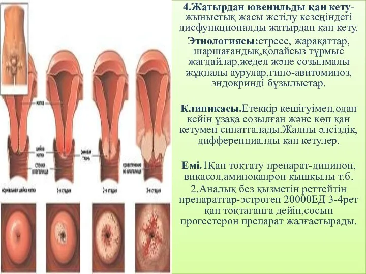 4.Жатырдан ювенильды қан кету-жыныстық жасы жетілу кезеңіндегі дисфункционалды жатырдан қан кету. Этиологиясы:стресс,