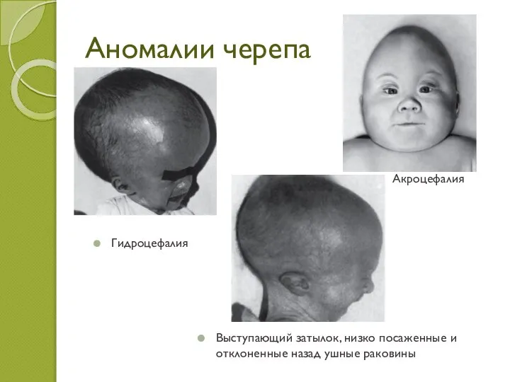 Аномалии черепа Гидроцефалия Акроцефалия Выступающий затылок, низко посаженные и отклоненные назад ушные раковины