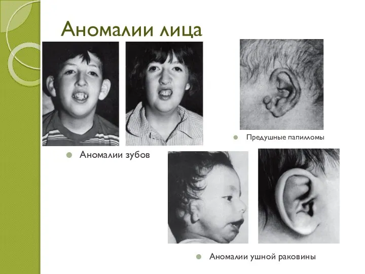 Аномалии лица Аномалии зубов Аномалии ушной раковины Предушные папилломы