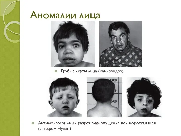 Аномалии лица Грубые черты лица (маннозидоз) Антимонголоидный разрез глаз, опущение век, короткая шея (синдром Нунан)