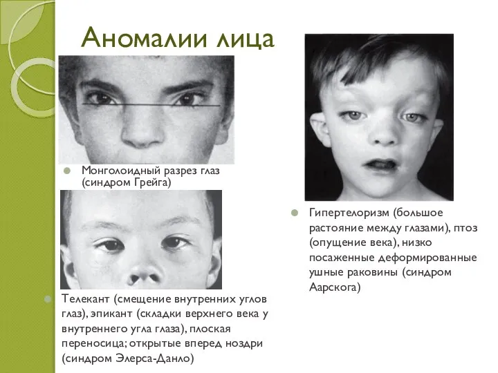 Аномалии лица Монголоидный разрез глаз (синдром Грейга) Телекант (смещение внутренних углов глаз),