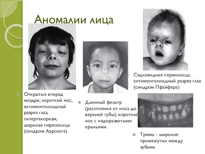 Аномалии лица Седловидная переносица, антимонголоидный разрез глаз (синдром Пфайфера) Длинный фильтр (расстояние