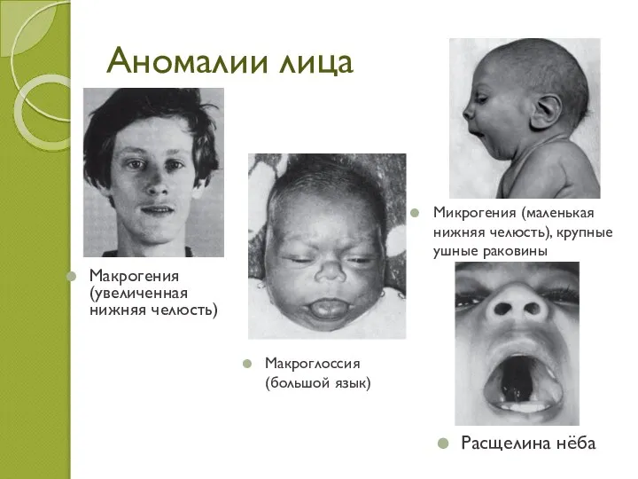 Аномалии лица Макрогения (увеличенная нижняя челюсть) Микрогения (маленькая нижняя челюсть), крупные ушные