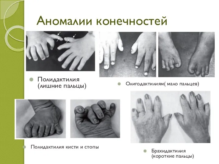 Аномалии конечностей Полидактилия (лишние пальцы) Брахидактилия (короткие пальцы) Олигодактилиям( мало пальцев) Полидактилия кисти и стопы