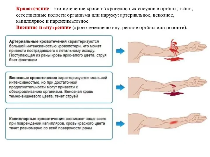 Кровотечение – это истечение крови из кровеносных сосудов в органы, ткани, естественные