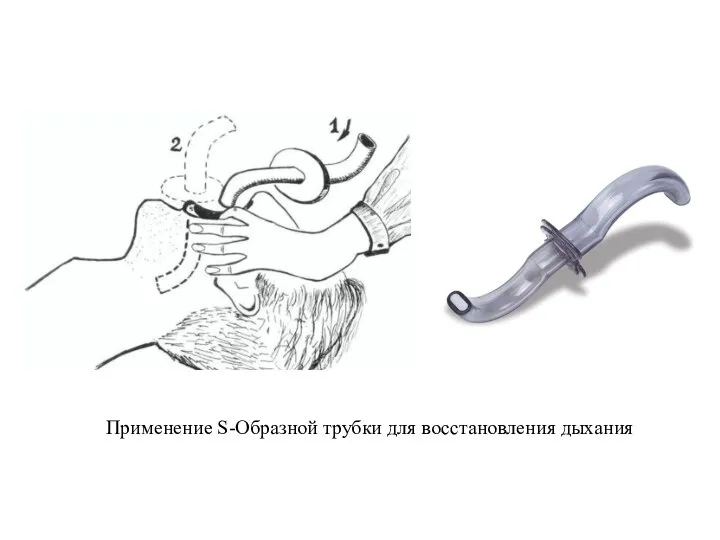 Применение S-Образной трубки для восстановления дыхания