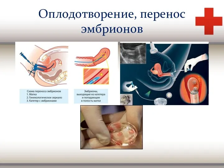 Оплодотворение, перенос эмбрионов