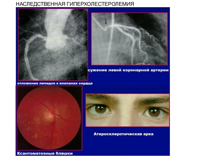 НАСЛЕДСТВЕННАЯ ГИПЕРХОЛЕСТЕРОЛЕМИЯ