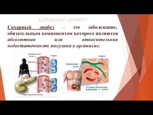 Сахарный диабет – это заболевание, обязательным компонентом которого являются абсолютная или относительная