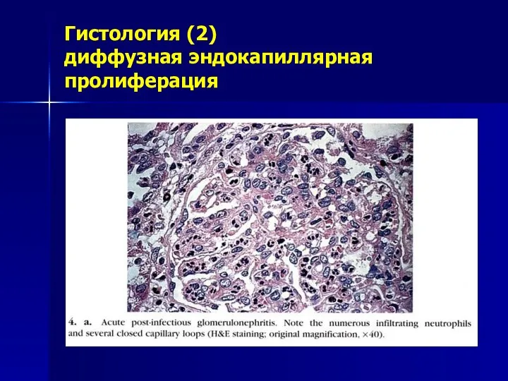 Гистология (2) диффузная эндокапиллярная пролиферация