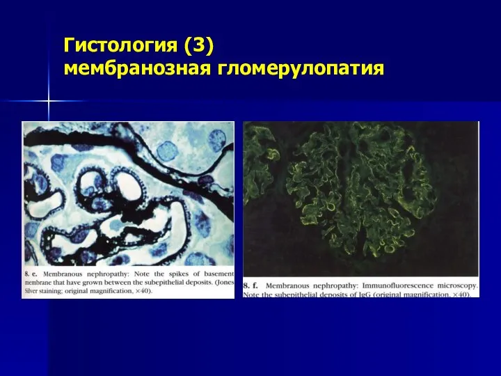 Гистология (3) мембранозная гломерулопатия