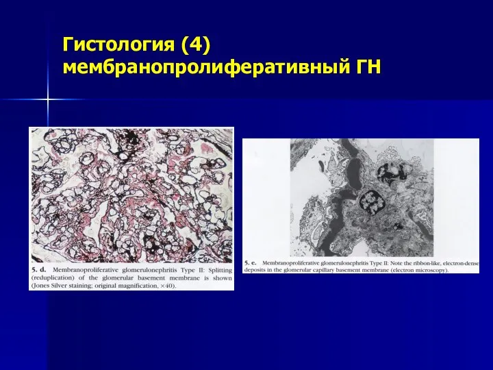 Гистология (4) мембранопролиферативный ГН