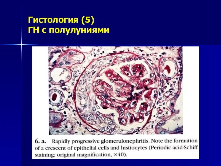 Гистология (5) ГН с полулуниями
