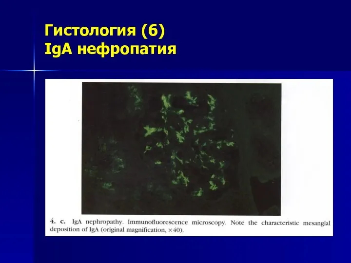 Гистология (6) IgA нефропатия