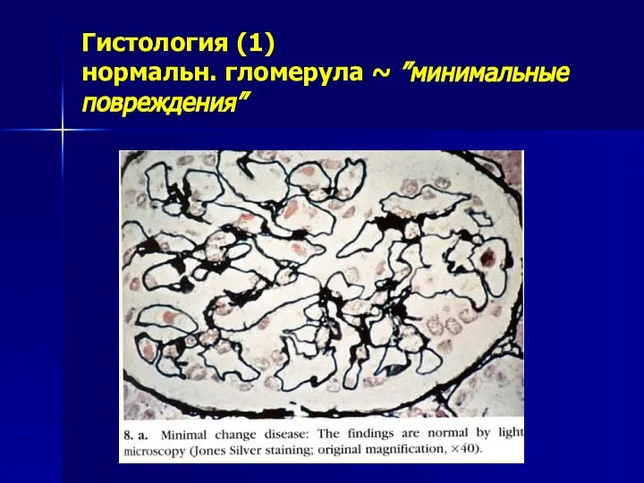 Гистология (1) нормальн. гломерула ~ ”минимальные повреждения”