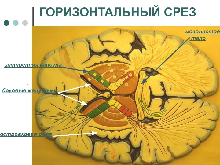 ГОРИЗОНТАЛЬНЫЙ СРЕЗ внутренняя капсула боковые желудочки островковая доля мозолистое тело