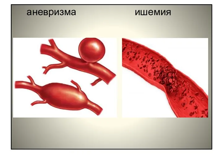 аневризма ишемия