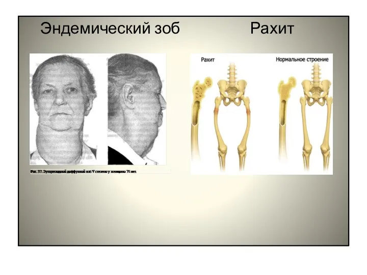 Эндемический зоб Рахит