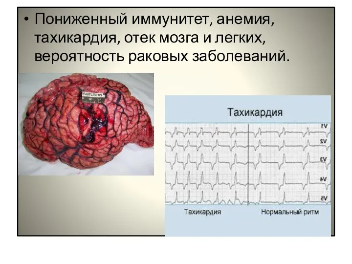 Пониженный иммунитет, анемия, тахикардия, отек мозга и легких, вероятность раковых заболеваний.