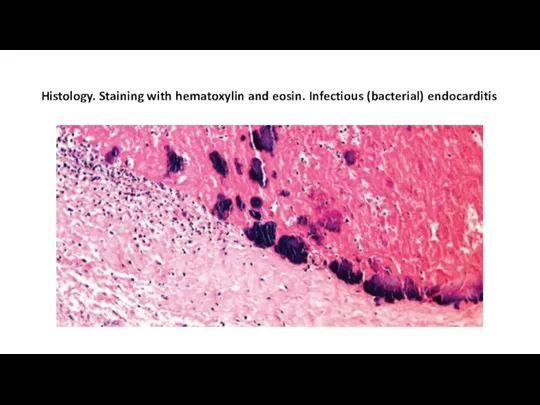 Histology. Staining with hematoxylin and eosin. Infectious (bacterial) endocarditis