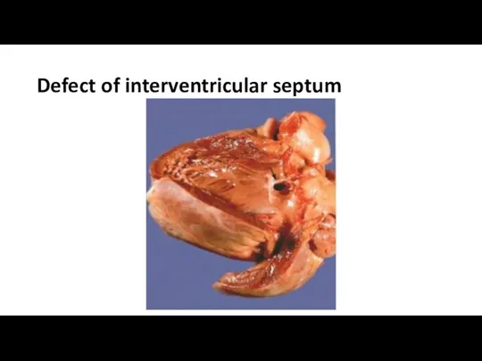 Defect of interventricular septum