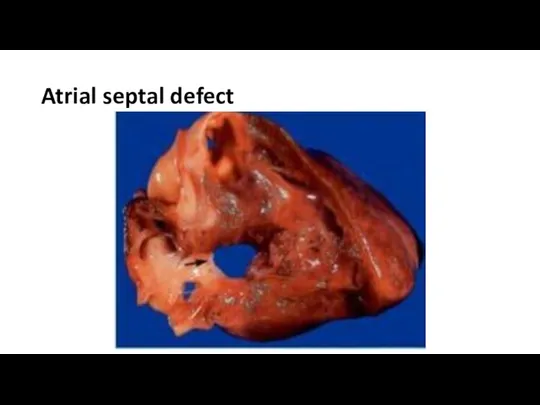 Atrial septal defect