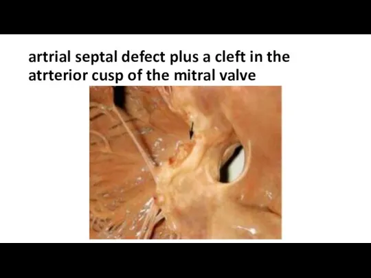 artrial septal defect plus a cleft in the atrterior cusp of the mitral valve