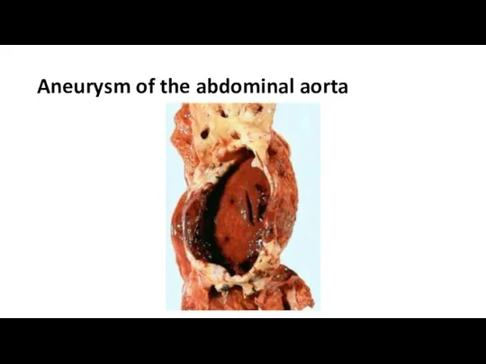 Aneurysm of the abdominal aorta