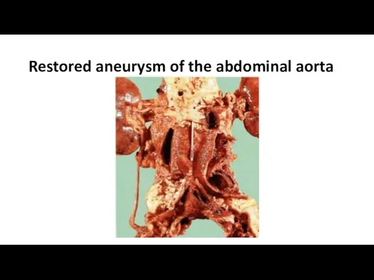 Restored aneurysm of the abdominal aorta