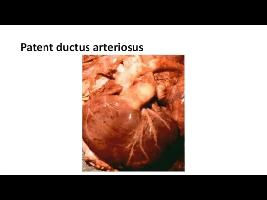 Patent ductus arteriosus