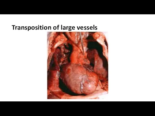 Transposition of large vessels