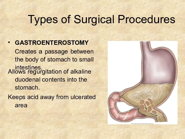 Types of Surgical Procedures • GASTROENTEROSTOMY Creates a passage between the body