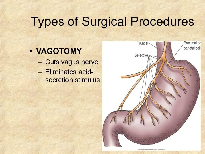 Types of Surgical Procedures VAGOTOMY Cuts vagus nerve Eliminates acid- secretion stimulus