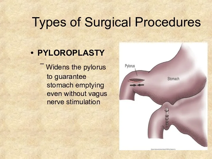 Types of Surgical Procedures PYLOROPLASTY – Widens the pylorus to guarantee stomach