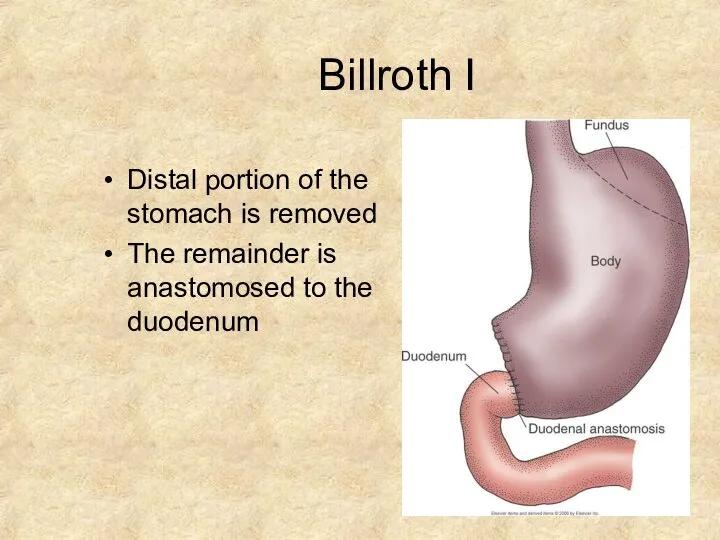 Billroth I Distal portion of the stomach is removed The remainder is anastomosed to the duodenum