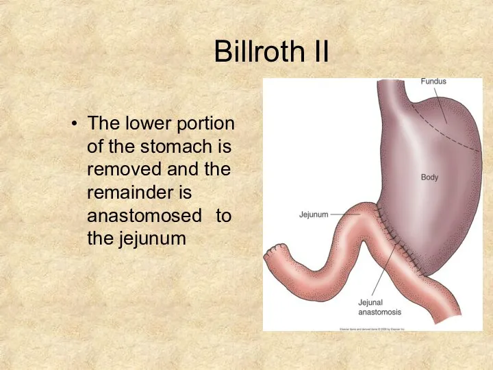 Billroth II The lower portion of the stomach is removed and the