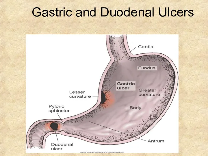 Gastric and Duodenal Ulcers
