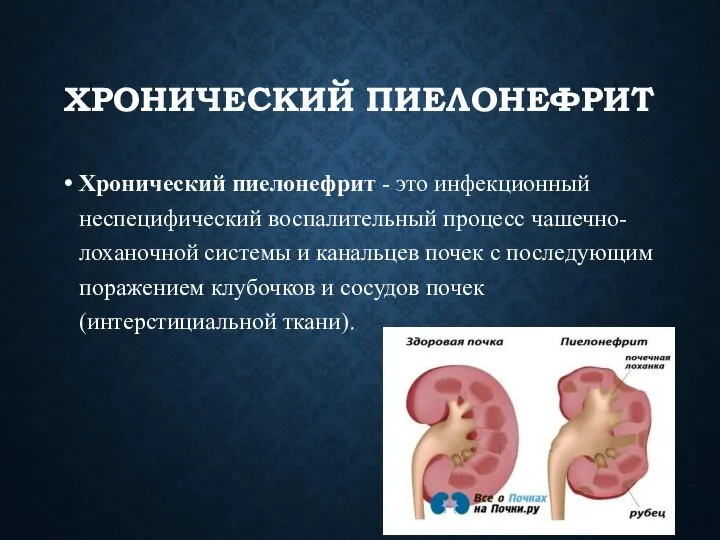 ХРОНИЧЕСКИЙ ПИЕЛОНЕФРИТ Хронический пиелонефрит - это инфекционный неспецифический воспалительный процесс чашечно-лоханочной системы