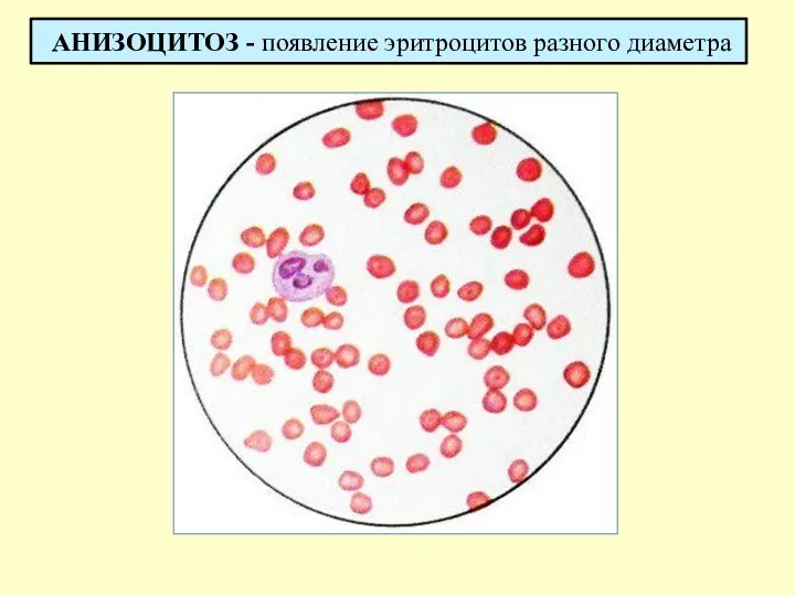 АНИЗОЦИТОЗ - появление эритроцитов разного диаметра