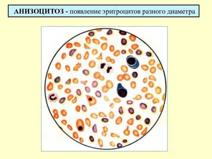 АНИЗОЦИТОЗ - появление эритроцитов разного диаметра