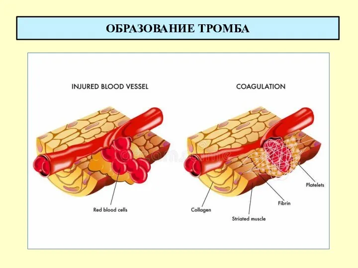 ОБРАЗОВАНИЕ ТРОМБА