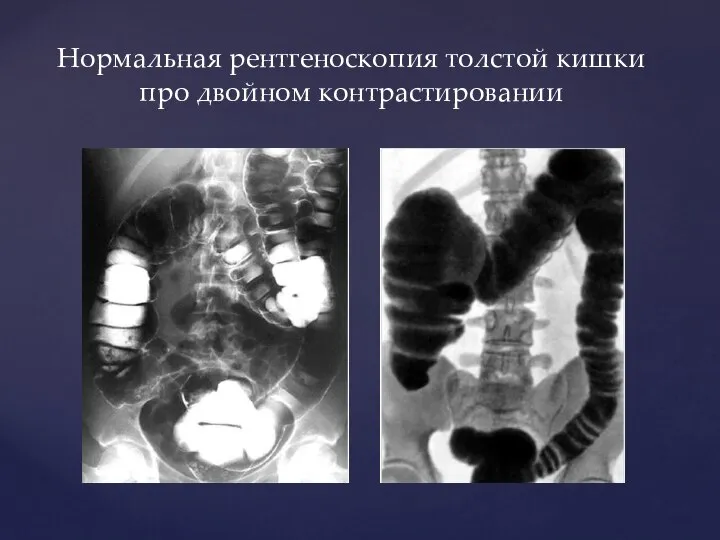 Нормальная рентгеноскопия толстой кишки про двойном контрастировании