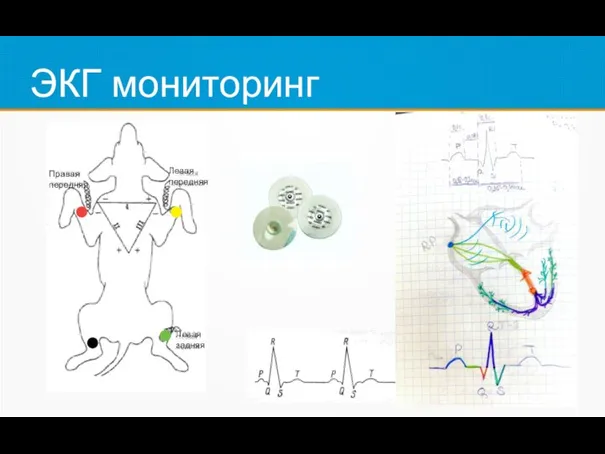 ЭКГ мониторинг Левая задняя Левая передняя Правая передняя