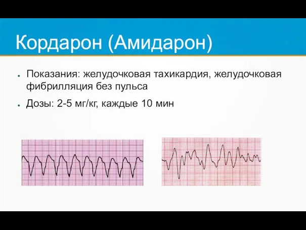 Кордарон (Амидарон) Показания: желудочковая тахикардия, желудочковая фибрилляция без пульса Дозы: 2-5 мг/кг, каждые 10 мин