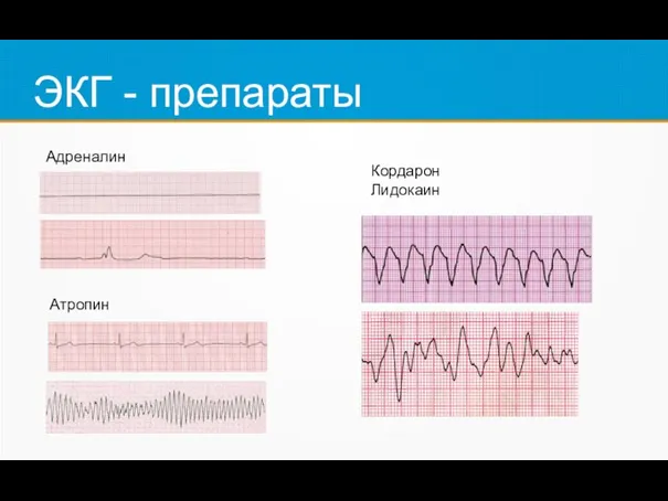 ЭКГ - препараты Адреналин Атропин Кордарон Лидокаин