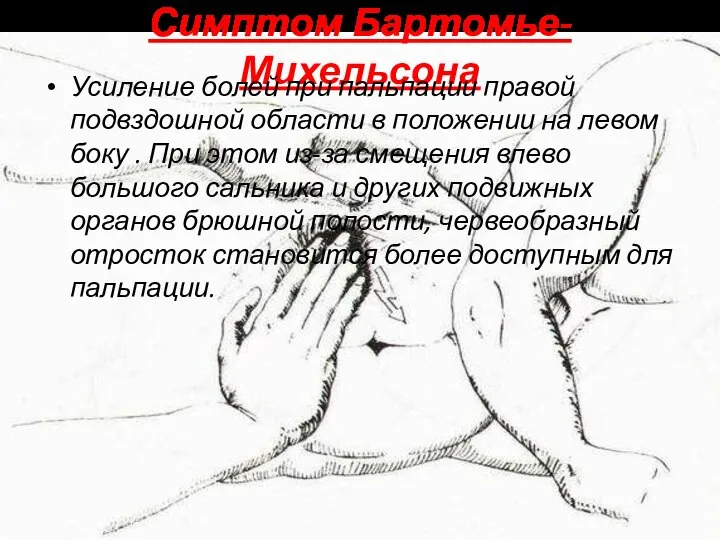 Симптом Бартомье-Михельсона Усиление болей при пальпации правой подвздошной области в положении на