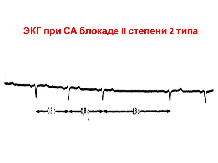 ЭКГ при СА блокаде II степени 2 типа