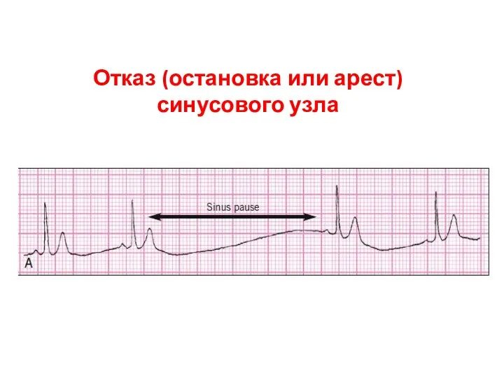 Отказ (остановка или арест) синусового узла