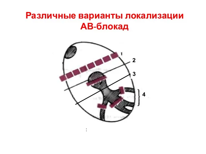 Различные варианты локализации АВ-блокад : 2 3 4