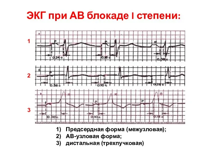 ЭКГ при АВ блокаде I степени: Предсердная форма (межузловая); АВ-узловая форма; дистальная (трехпучковая) 1 2 3